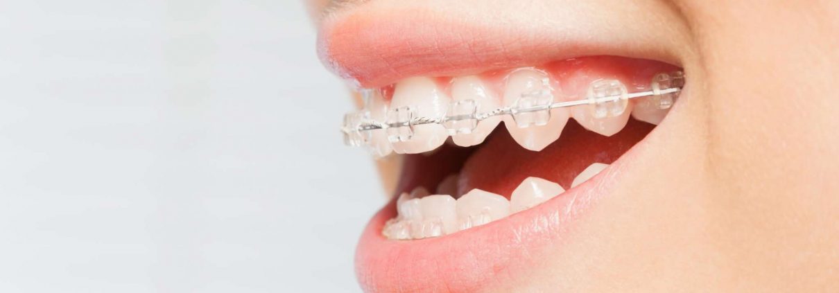 Clear Aligners, Braces You Can't See